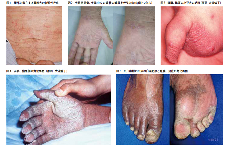 図1 腹部に散在する粟粒大の紅斑性丘疹　図2 手関節屈側、手掌中央の線状の鱗屑を伴う皮疹（疥癬トンネル） 図3 陰嚢、陰茎の小豆大の結節（原図 大滝倫子） 図4 手掌、指屈側の角化局面（原図 大滝倫子） 図5 爪白癬様の爪甲の白濁肥厚と趾腹、足底の角化局面 