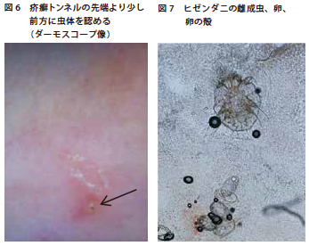 図6 疥癬トンネルの先端より少し前方に虫体を認める(ダーモスコープ像)　図7 ヒゼンダニの雌成虫、卵、卵の殻